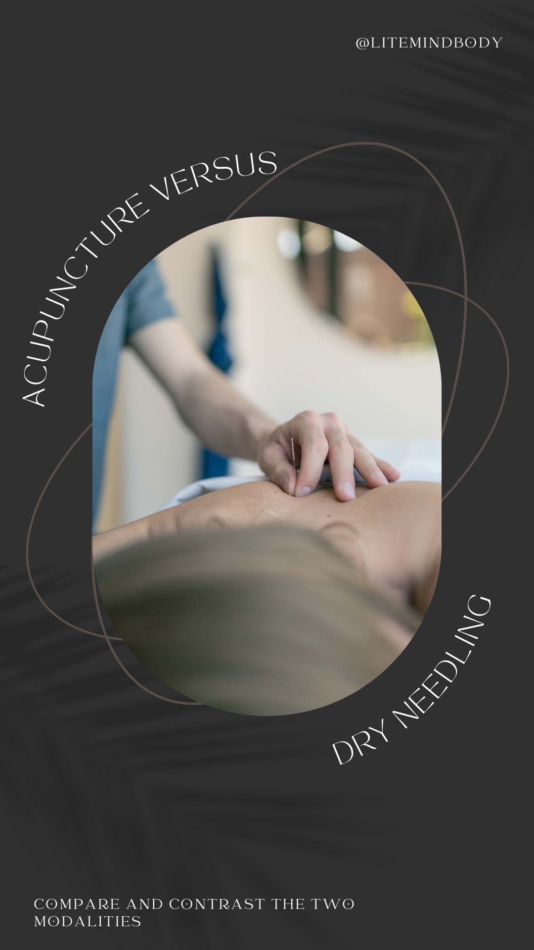 Dry Needling versus acupuncture